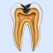 Plaque can lead to cavities and tooth decay