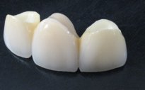 A dental bridge can fill the gap left by a missing tooth.