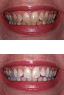 Teeth whitening treatment can improve your smile