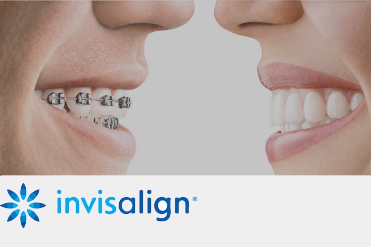 Invisalign or braces for straightening teeth